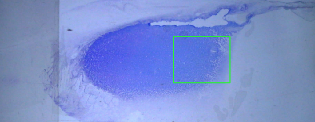 The sample on the slide has a thick blue appearance, which can indicate a high protein concentration, high cellularity, or both.