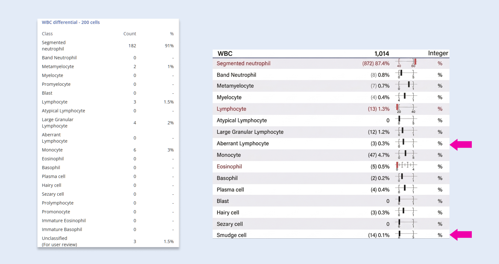 Comparison showing a 200-cell differential detecting mainly segmented neutrophils and lymphocytes, while the CBM Analyzer's 1,014-cell differential also surfaces low-frequency aberrant lymphocytes, hairy cells, large granular lymphocytes and smudge cells.